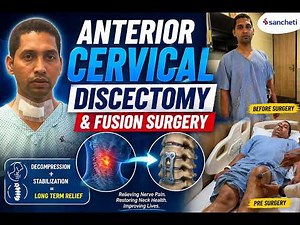 ACDF Surgery Recovery | Anterior Cervical Discectomy and Fusion | Dr. Ajay Kothari