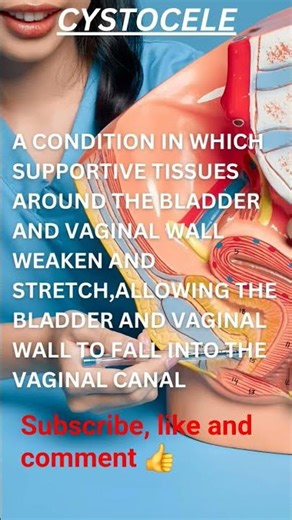 prolapsed bladder##urinarysymptoms ##medical knowledge #nursinglife