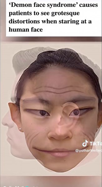A rare condition where someone will see another humans face appear as if its morphing, known as having, “Demon Face Syndrome” • • • • #demonface #conspirancytheory #raredisease #yolhartnetwork #scaryvideos #conspiracytiktok