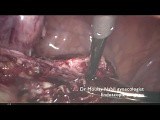Bloodless Outpatient Myomectomy • Video • MEDtube.net