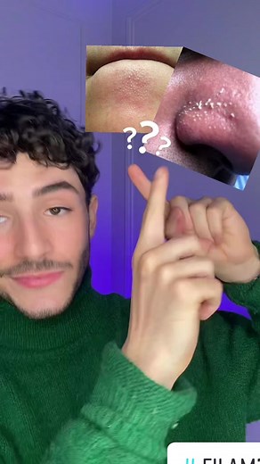 ✅🧪 Si tu as des filaments sebacés sur le nez ou ailleurs ne t’inquiètes pas c’est totalement normal et naturel mais voici ce que tu dois utiliser si tu veux éliminer tes filaments sébacés. 🔬 Les filaments sébacés sont des petits fils blancs qui se trouvent dans les pores. Ils sont constitués de sébum et permettent à ce dernier de s’écouler naturellment à la surface de la peau. ❌ Pour les retirer n’utilises pas de patchs peel-of, sur le long terme ca ne sert à rien et en plus ca abime la barriè