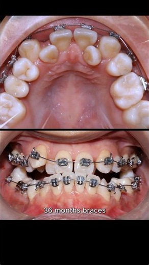 Magic of braces: fix extremely crowded teeth #braces #orthodontist #orthodontics #brackets #dentist