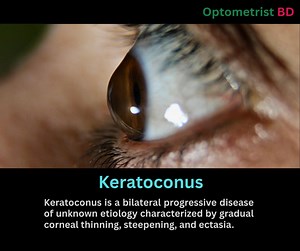 Classical signs of keratoconus #optometristbd #optometrist #jobs #education #eyecare #personalgrowth | Optometrist BD