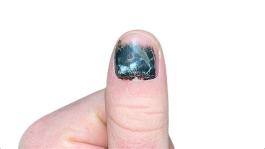 Fingernail healing process.