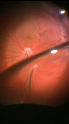 Effective removal of vitreous from mobile retina and the tears before settling the detached retina