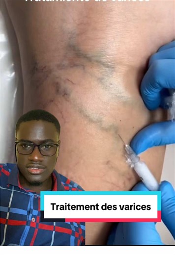 Sclérothérapie : Traitement des varices expliqué