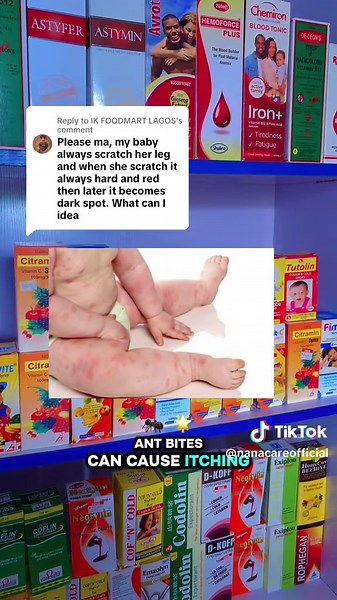 Managing Baby Eczema: Tips for Healthy Skin