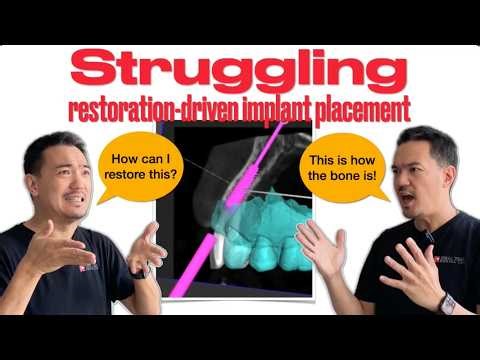 How to Achieve Restoration-Driven Implant Placement (RealGUIDE Tutorial using DAS Guided Kit)