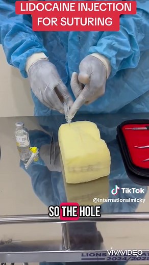 Lidocaine Injection Techniques for Suturing Procedures