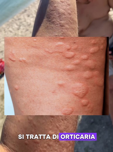Cos'è l'orticaria e come si manifesta?