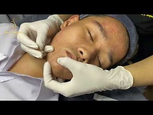 Loan Nguyen Acne Treatment #317