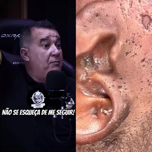 Blackhead Extraction Procedure on Ear: Step-by-Step Guide