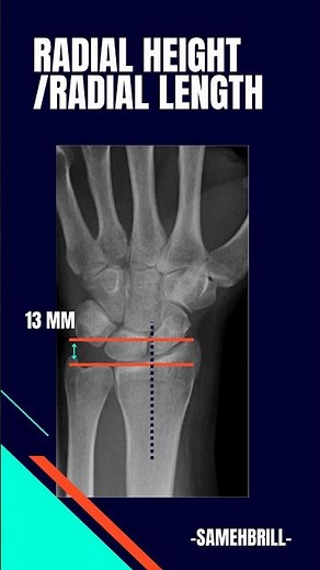 Distal radius fracture radiographic evaluation: Radial height