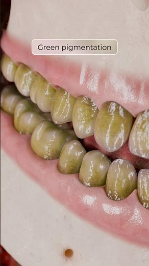 Congenital Hyperbilirubinemia: Tooth Discoloration and Enamel Defects in 3D