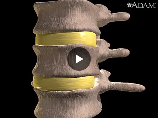 Spinal Disc Bulge Explained by Pothireddy Surendranath Reddy – Pathology, Causes, Symptoms, Diagnosis, and TreatmentA spinal disc bulge is a common degenerative spinal condition that affects the… | Pothireddy Surendranath Reddy