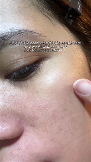 Rejuran Pore Tightening: Results After Two Weeks