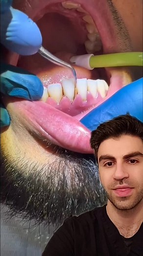 Understanding Tartar and Gum Health in Dental Care