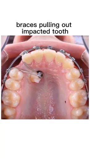 Bio Medical Explanaing on Instagram: "This shows an orthodontic technique used to help bring an impacted tooth into its proper position using braces. An impacted tooth is one that hasn’t erupted normally through the gums, often because it’s blocked by other teeth or doesn’t have enough space. This commonly happens with canines (eye teeth) and wisdom teeth. In cases where the tooth can be saved, an orthodontist may surgically expose it and attach a small bracket or chain. Gentle, controlled press