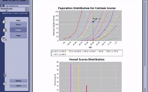 钙化积分SmartScore后处理软件操作演示