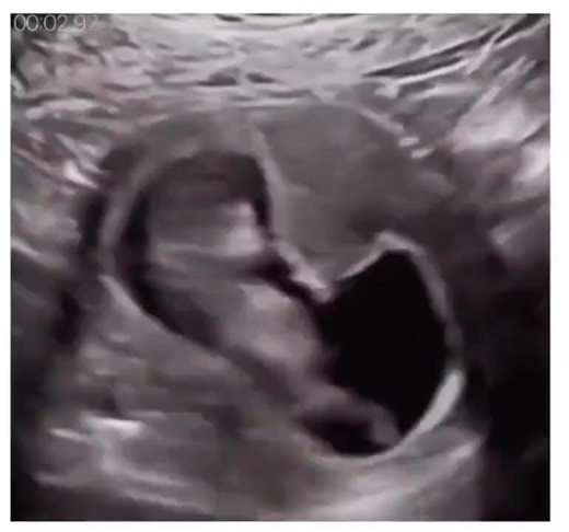 Baby hiccupping in the womb! 😇 | LifeNews.com