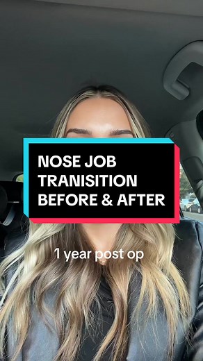 3 Months to 1 Year: Nose Job Transition Before & After