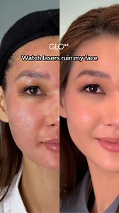 3.3K views · 69 reactions | This is what laser magic looks like! ✨ Check out @dieplinhchau 's Fractional Laser before & after. The results speak for themselves! What do you think? Let me know in the comments! #glo365 #beauty #Picosure #laser #scartreatment | Glo365 Medical Group | Facebook
