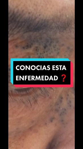 Los comedones abiertos o espinillas es lo que más llama la atención en esta enfermedad 😱 ... se produce por daño solar en la piel.... Recuerda que es importante utilizar el protector solar diariamente, uso de sombrero, lentes uv .. Protege tu piel y disfruta del verano 😉🌞‼️ #dermatologia #limaperu #peru #comedones #peru2023 #acne