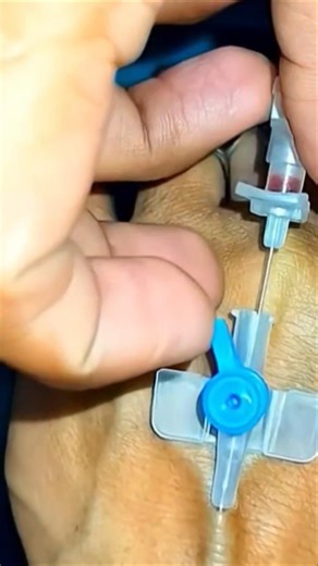 iv cannulation#hospital #youtube#youtuber #youtubeshorts #youtubeshort #vigo #emergency #icu