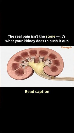 The real pain isn’t the stone — it’s what your kidney does to push it out.