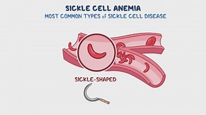 Video: Sickle Cell Anemia - Video Explanation! | Osmosis | Osmosis