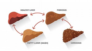5.3K views · 51 reactions | Hepatitis, Fibrosis, Cirrhosis, Steatosis - you've heard of all these terms before, but what do they mean? They can all be a bit confusing, though for many liver diseases the advancement follows the same course. Learn more about the progression of liver disease by watching our short new animated video! | American Liver Foundation | Facebook