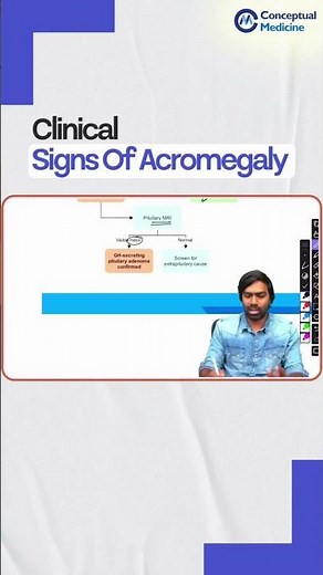 Clinical Signs of Acromegaly By Dr. Dilip kumar | Medicine Residency