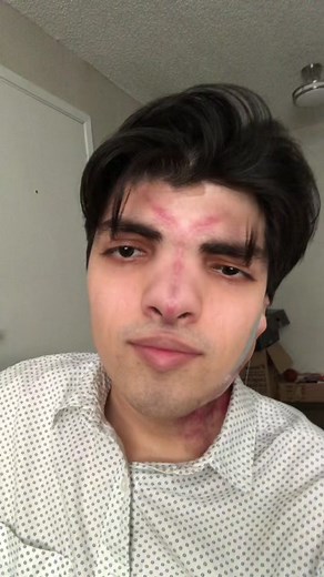 I struggle to control that eye #failedfirebender #zuko #burnsurvivor #asymmetricalface