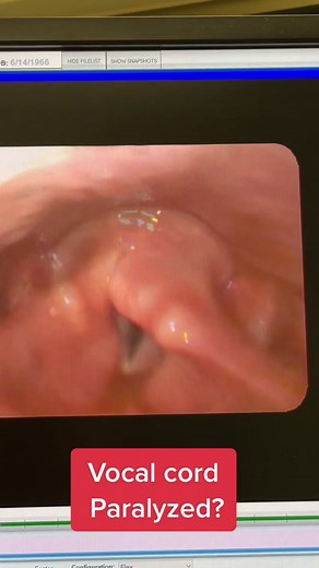 Vocal Cord Paralysis: What It Looks Like & Treatment