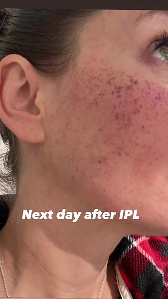Reverse Sun Damage with IPL Treatment