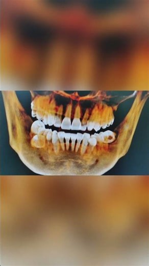 How to remove an impacted wisdom tooth? #satisfying #wisdomtoothextraction