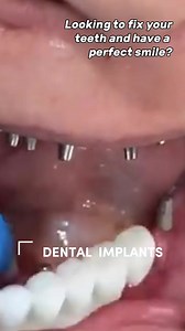 5.6K views · 28 reactions | Do Not Pay $2,000 Per Implant: Full mouth or single tooth procedures available (pricing on the next page)  | Body Hacks | Facebook