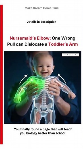 🤱 Nursemaid’s Elbow: One Wrong Pull ⚠️ Can Dislocate a Toddler’s Arm 🧑‍⚕️ | MDCT