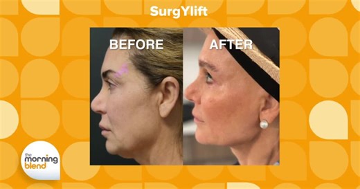 Minimally Invasive Neck and Face Lift
