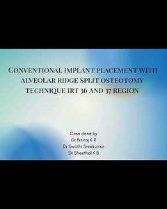 Conventional implant placement with alveolar ridge split osteotomy technique irt 36 and 37 region.