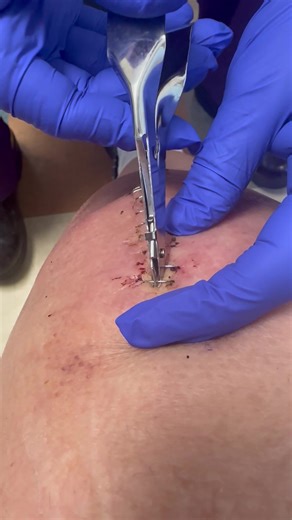 Removing Surgical Staples: A Recovery Experience