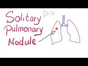 Solitary Pulmonary Nodule (SPN): How to manage it!