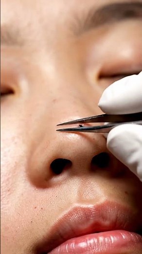 😱EXTREME Blackhead Removal! You Won't Believe It! 💥 (Satisfying)