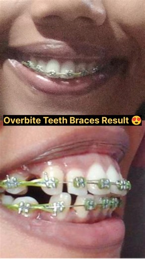 Overbite Teeth Braces 😍Transformation 🔥ll 15 Months time #orthodontist #braces #dentist