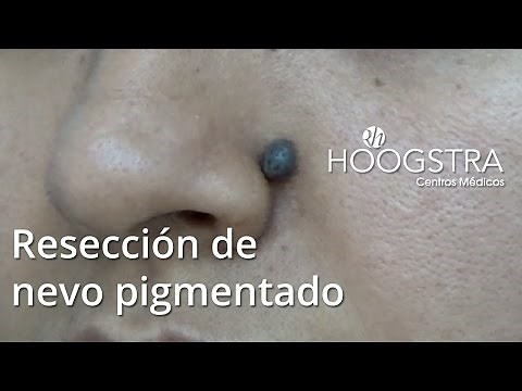 Resección de nevo pigmentado (15025)