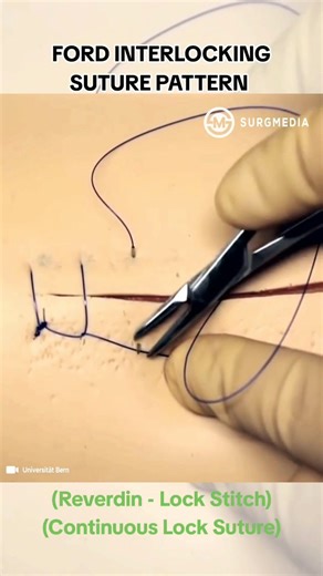 Ford Interlocking Suture Pattern Techniques