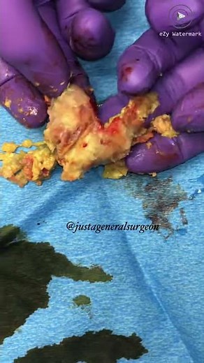 Inside the OR with @justageneralsurgeon - Cutting open that huge cyst from the previous two videos