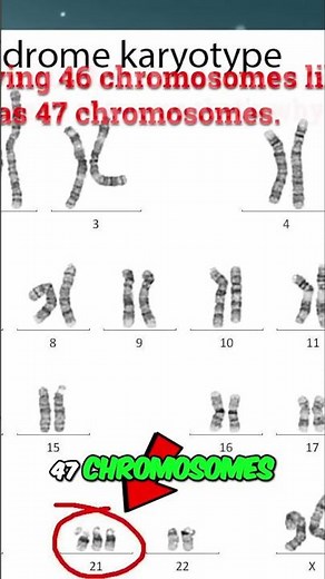 Down Syndrome: Understanding Trisomy 21 Explained #shorts