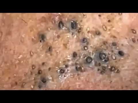 Deep Pore Cleaning: Removing Hardened Blackheads & Whiteheads [Part 05]
