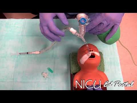 NICU Procedures- Surfactant administration in a preterm infant
